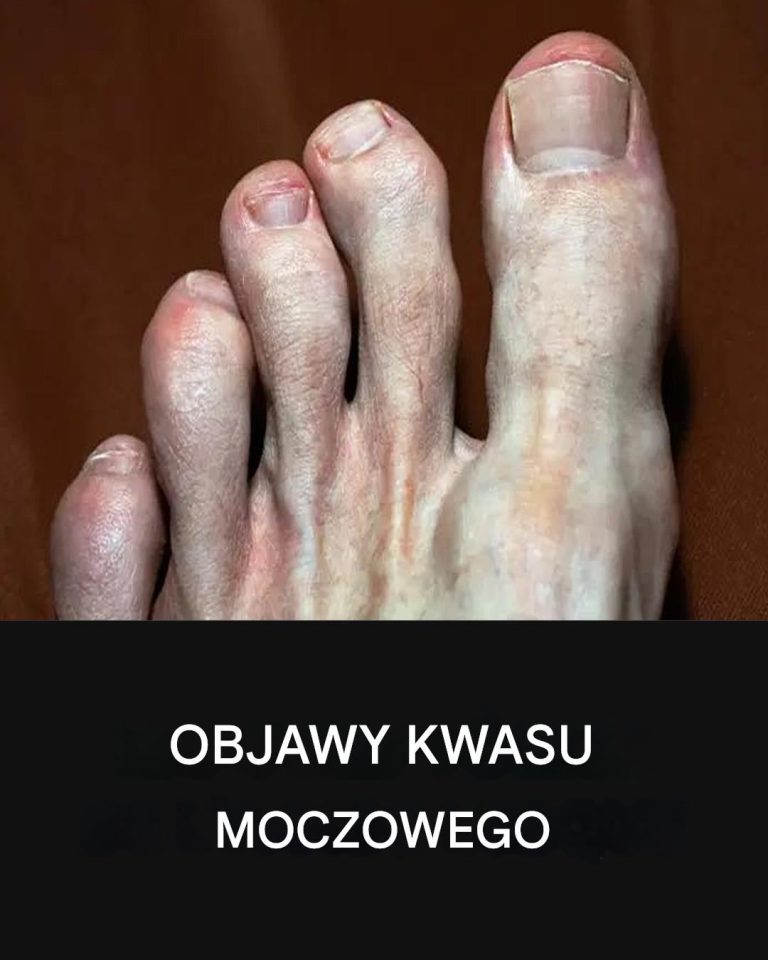 Produkty spożywcze, których należy unikać, aby zapobiec atakowi dny moczanowej