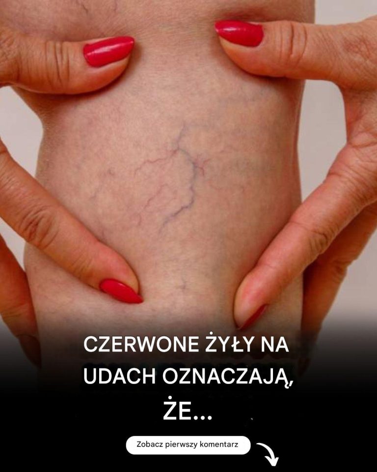 Jak usunąć żylaki?