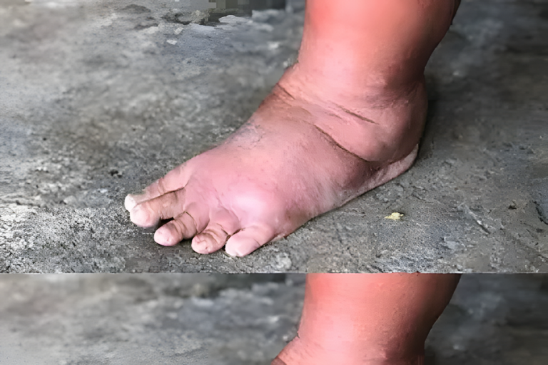 Najważniejsza witamina eliminująca obrzęki rąk, nóg i stóp