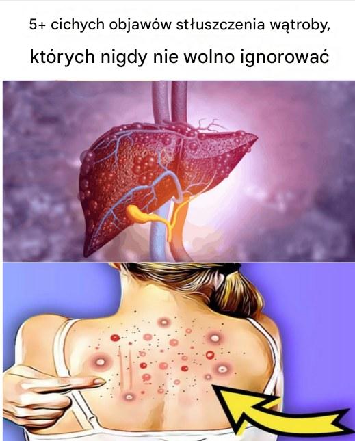 5 cichych objawów stłuszczenia wątroby, których nigdy nie wolno ignorować