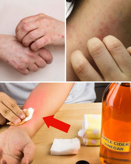 Te 4 problemy skórne można złagodzić, stosując ocet
