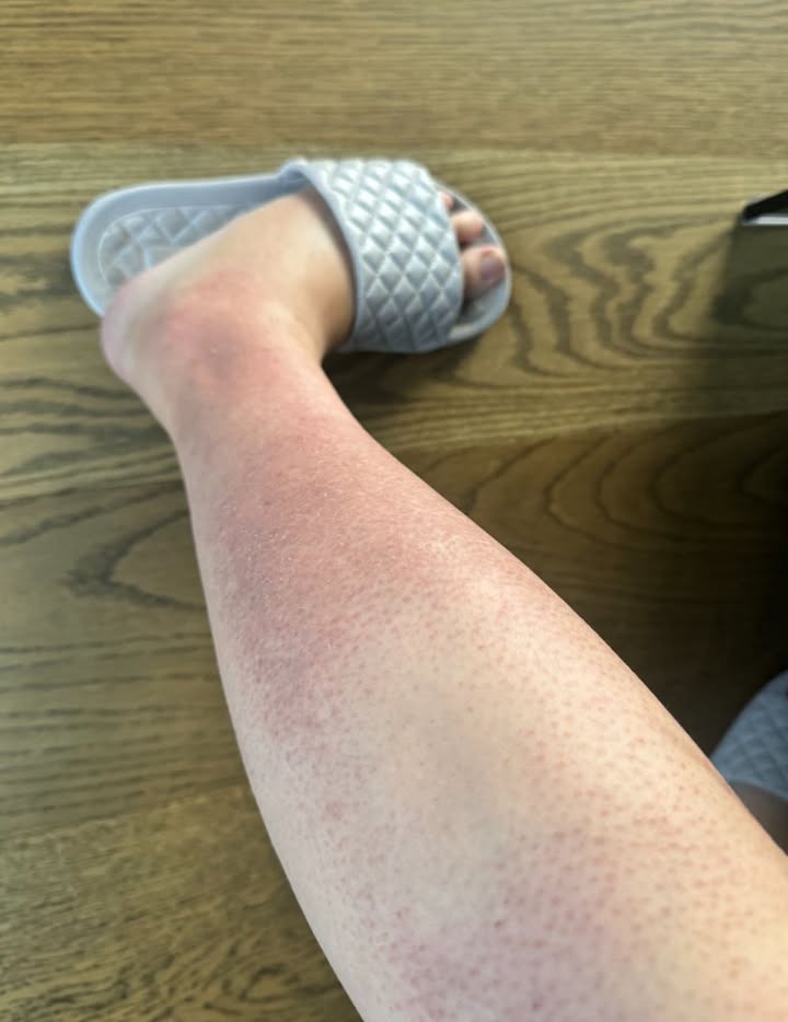 Jestem w 18. tygodniu ciąży i mam okropną wysypkę na nogach. Swędząca i grudkowata skóra. Nie mogę umówić się na wizytę u ginekologa w najbliższym czasie. Co mogę zrobić, aby uzyskać ulgę?