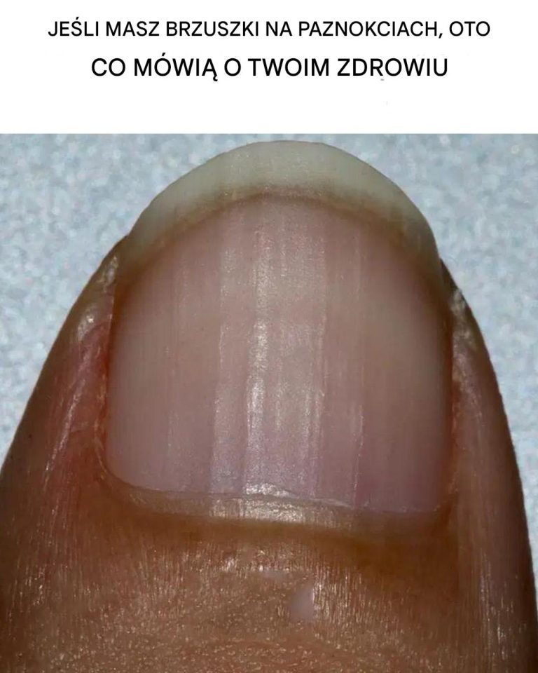 Jeśli masz bruzdy na paznokciach, oto co to mówi o Twoim zdrowiu