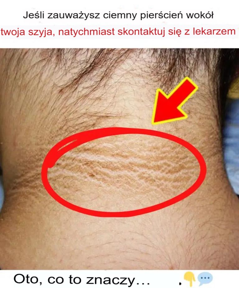 Jeśli zauważysz ciemną obwódkę wokół szyi, natychmiast udaj się do lekarza! Oto, co to oznacza