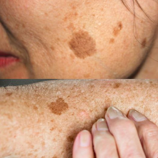 Najlepszy minerał do usuwania plam starczych