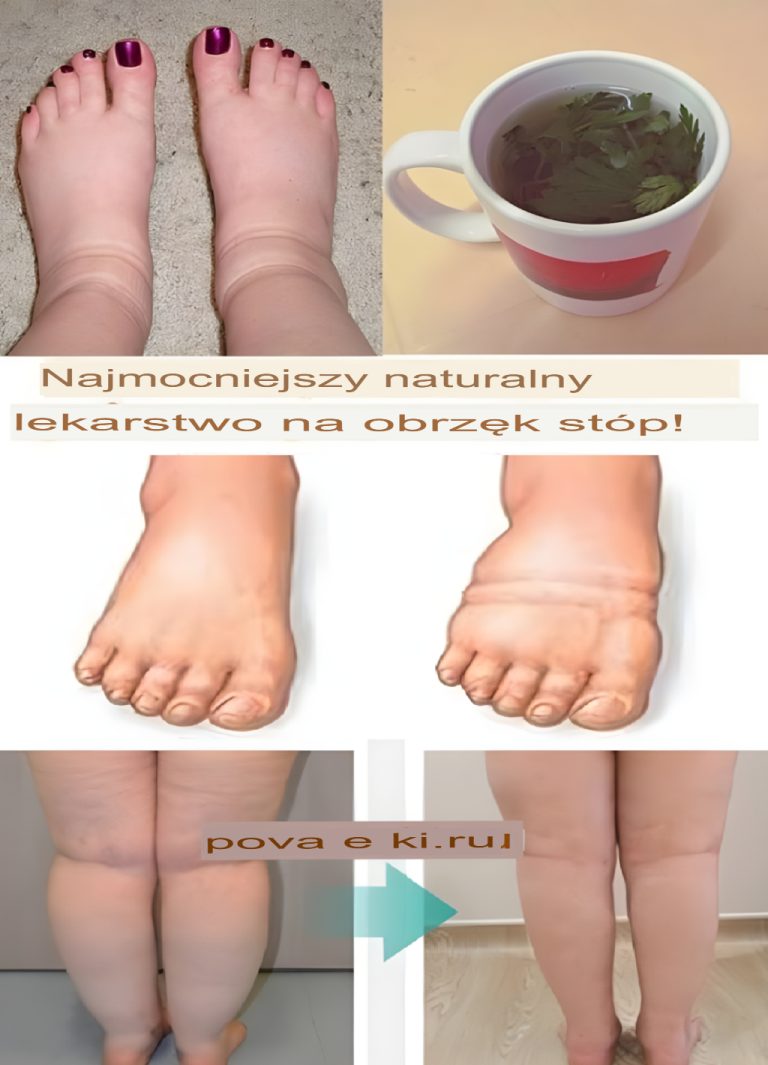 Najskuteczniejszy naturalny sposób na opuchnięte nogi!