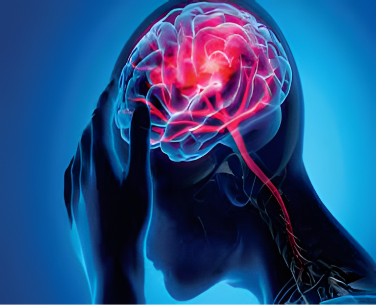 Udar mózgu: przyczyny, objawy i leczenie