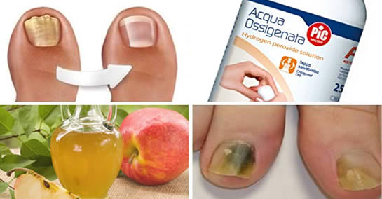 Grzybica paznokci: jak pozbyć się jej na zawsze za pomocą octu i wody utlenionej