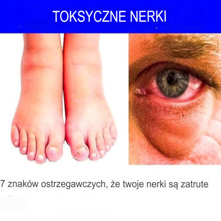 7 ostrzegawczych sygnałów, że Twoje nerki są toksyczne