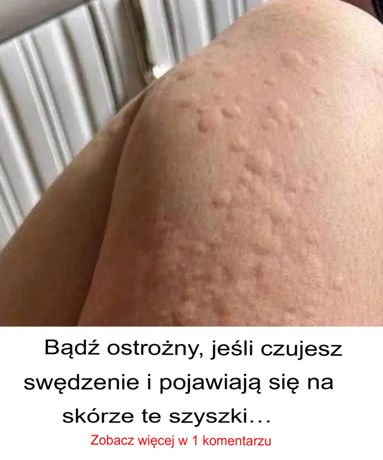 Dlaczego na skórze pojawia się pokrzywka? Oto zaskakujące fakty, których możesz nie znać.