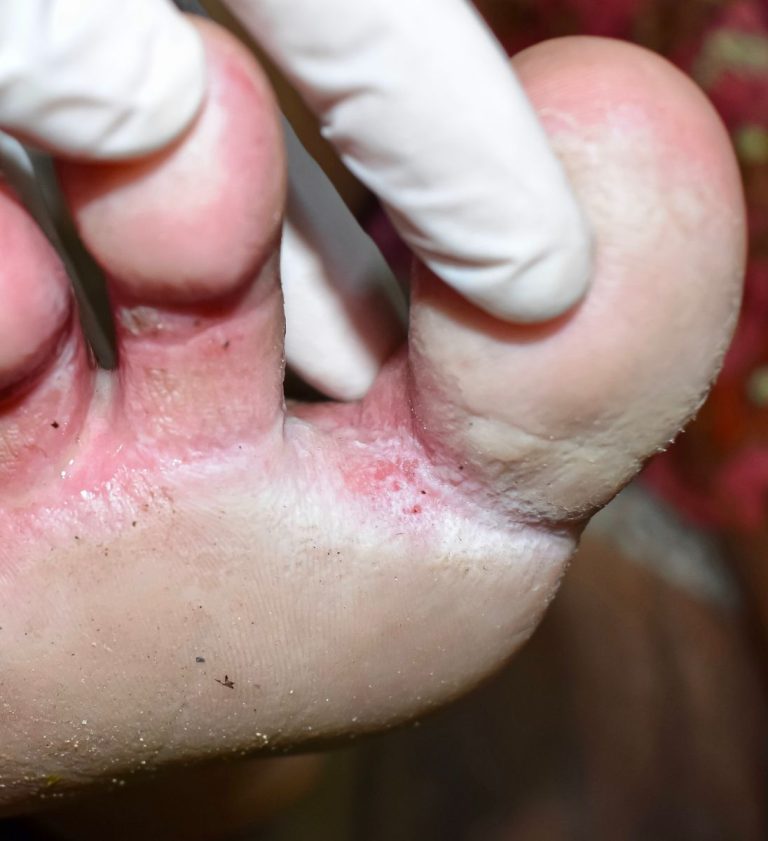 Wygląda to na infekcję między palcami u stóp. Nie mogę teraz iść do lekarza. Czy są jakieś dostępne bez recepty środki zaradcze?