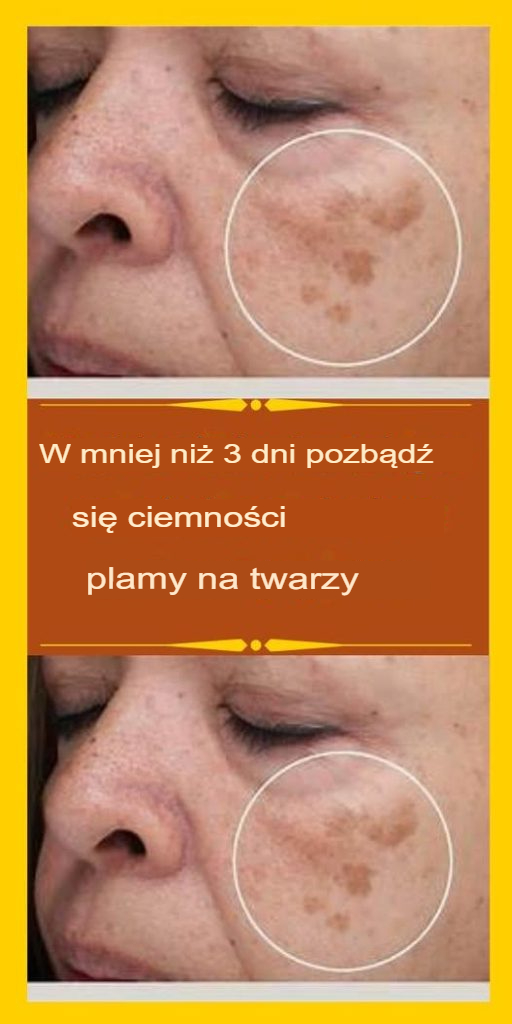 Naturalna babcina rada, jak szybko pozbyć się pieprzyków i pieprzyków