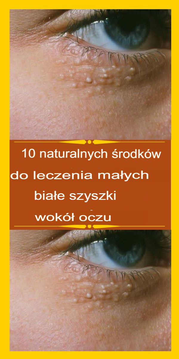 10 naturalnych środków na leczenie małych białych guzków wokół oczu - MonMag