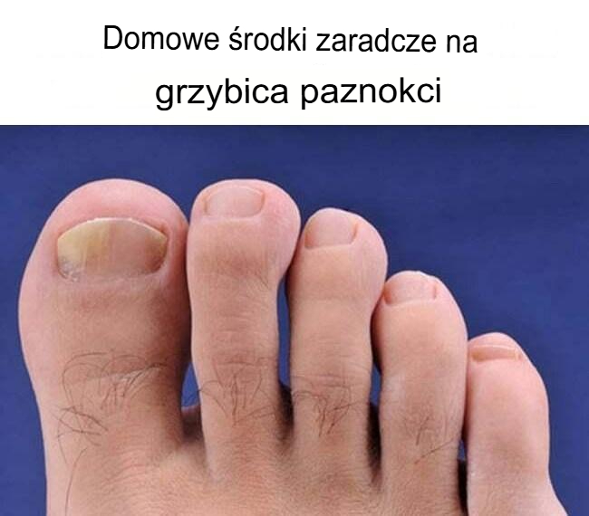 Domowe sposoby na grzybicę paznokci