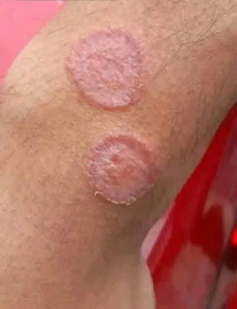 Pokrzywka – sygnał ostrzegawczy, którego nie należy ignorować