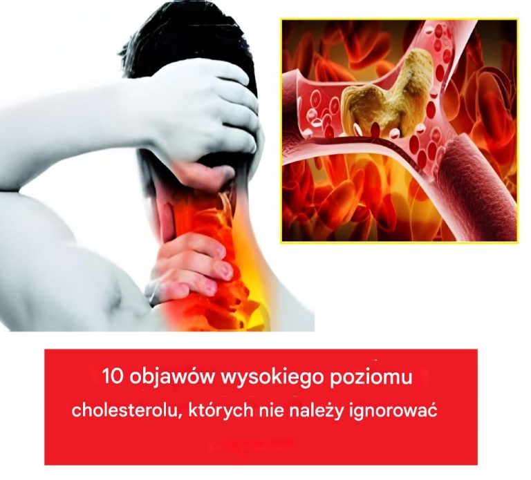 10 objawów wysokiego poziomu cholesterolu, których nie należy ignorować