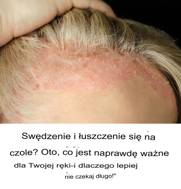 Nagłe łuszczenie i swędzenie na czole? Powód Cię przestraszy – a Twój lekarz już wie!