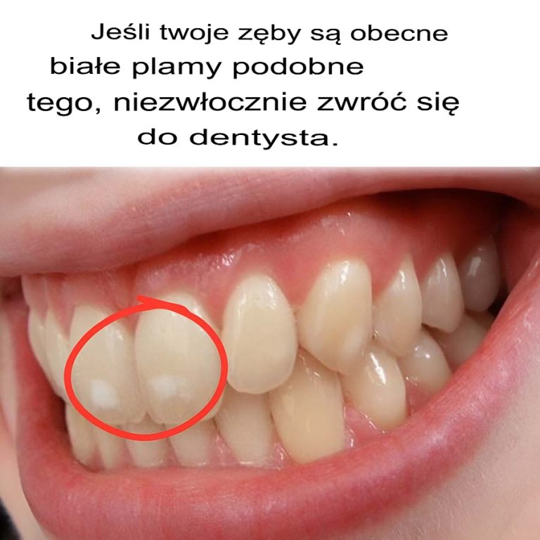 Jeśli zauważyłeś u siebie białe plamki na zębach, potraktuj to poważnie.