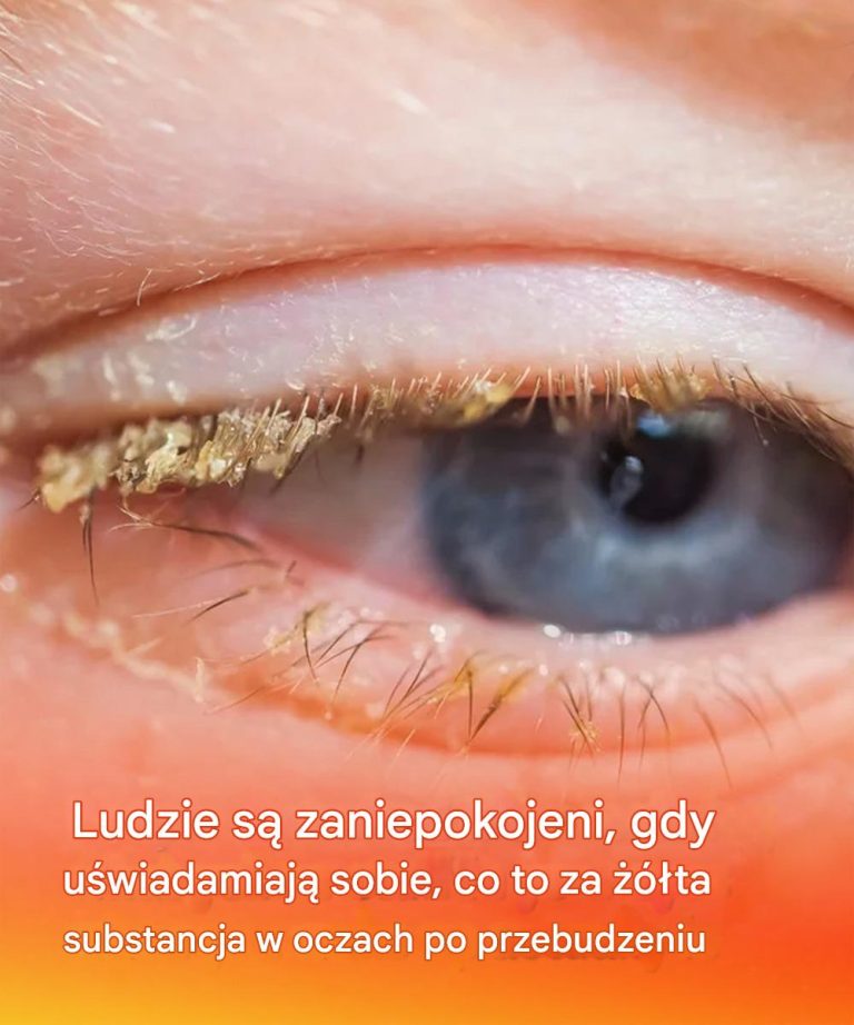 Ludzie są zaniepokojeni, gdy uświadamiają sobie, co to za żółta substancja w oczach po przebudzeniu