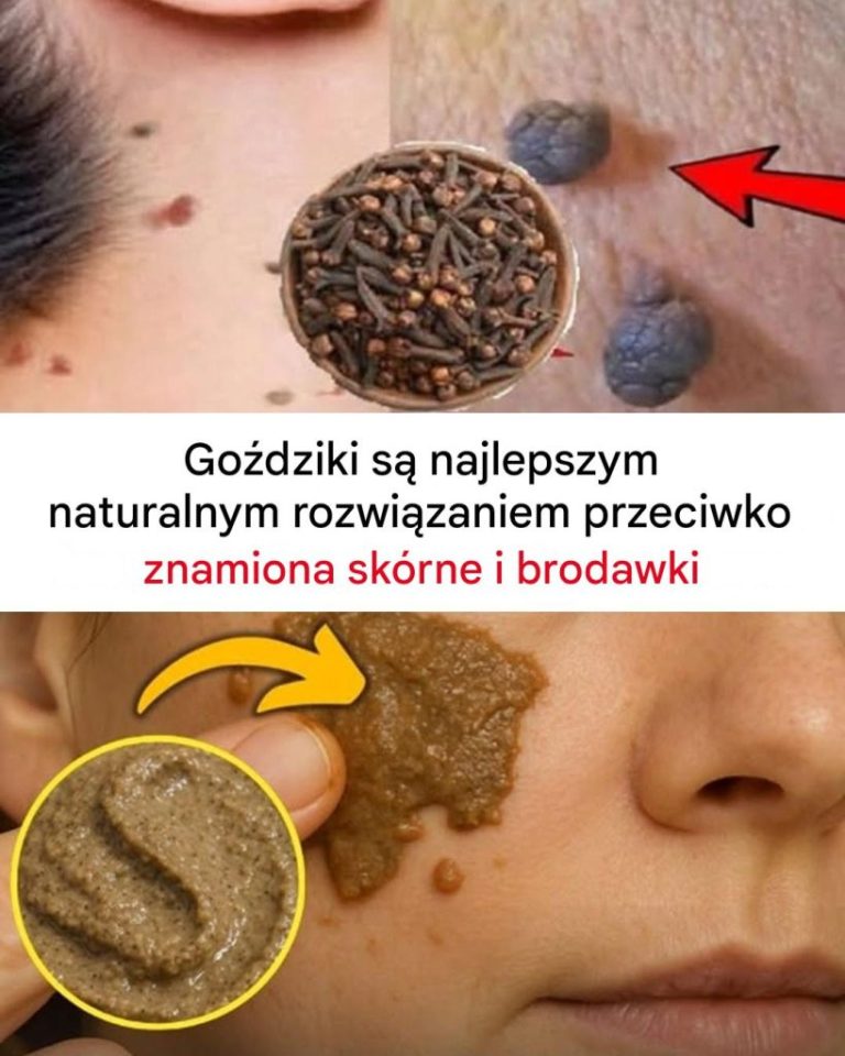 Goździki usuwają narośla skórne i brodawki: Jak je stosować?