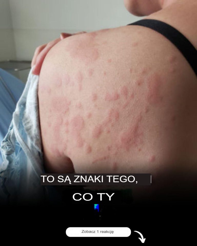 Pokrzywka? Alergia? Całe ciało ją swędziało, lekarze zdiagnozowali najgorsze