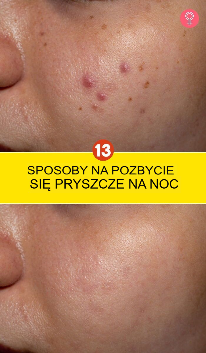 13 sposobów na pozbycie się pryszczy w ciągu nocy