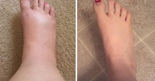 Opuchnięte kostki: Jak pozbyć się ich naturalnie w kilka minut