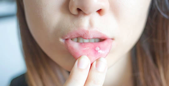 Afta w jamie ustnej może być objawem jednej z tych 6 chorób