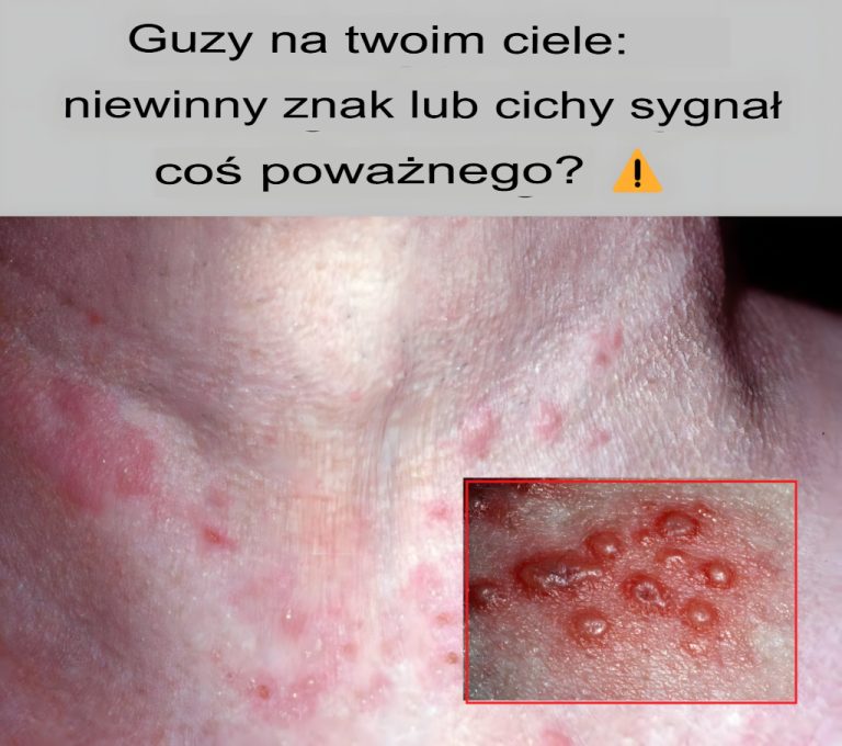 Wydają się małe i niegroźne, ale mogą wskazywać na ukryte schorzenia. Odkryj możliwe przyczyny i jak bezpiecznie je leczyć, zanim będzie za późno!