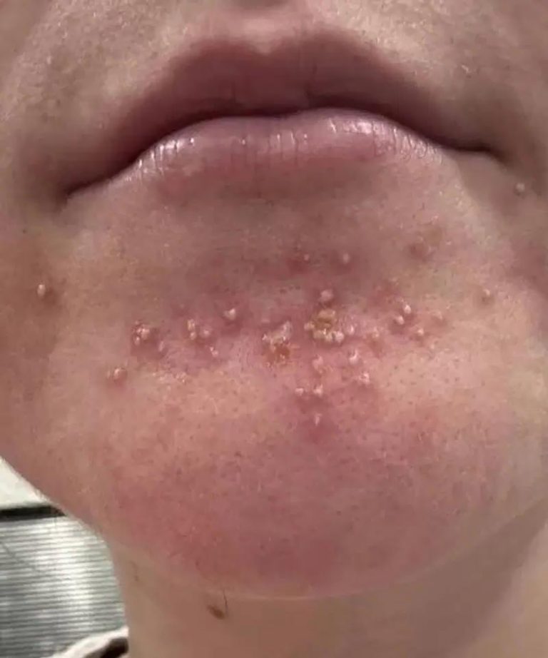 Pryszcz na brodzie: Ukryty sygnał od Twojego ciała?