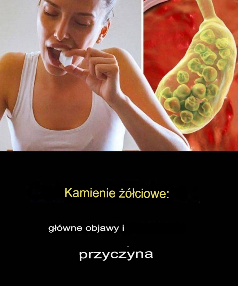 Kamienie żółciowe: czym są, objawy, przyczyny i leczenie