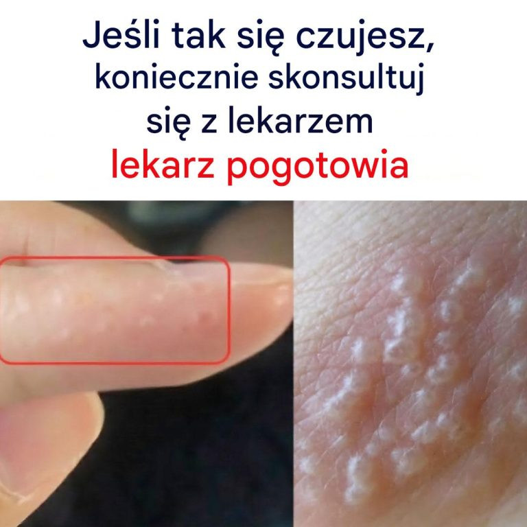 eśli zauważysz te czerwone i bolesne grudki, możesz cierpieć na tę chorobę.