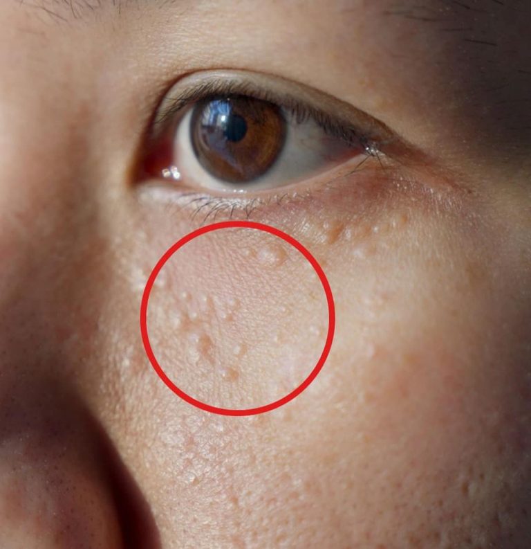 Jak pozbyć się prosaków i uciążliwych torbieli tłuszczowych