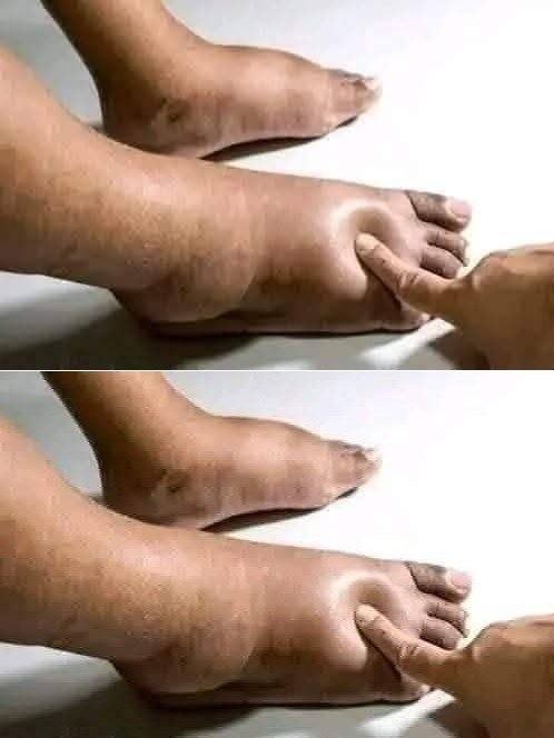 Owoc, który może pomóc zmniejszyć opuchliznę stóp 🍍✨