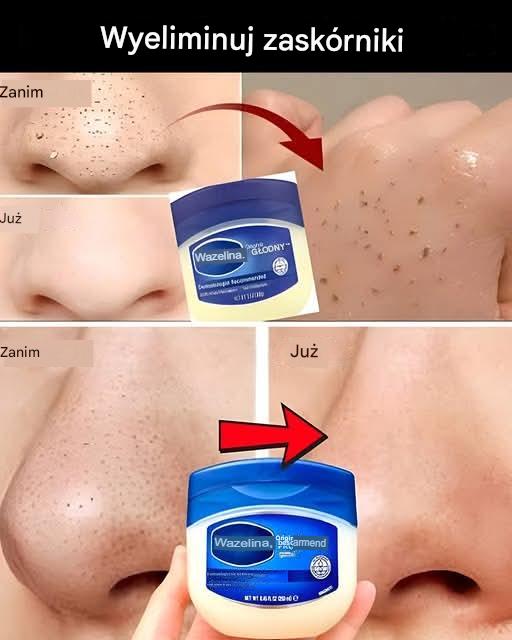Nieoczekiwane lekarstwo na niedoskonałości twarzy: wazelina jako sojusznik w świecie urody