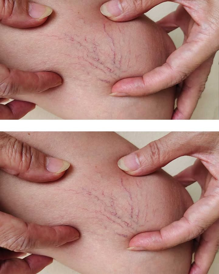 Te czerwone żyły rozprzestrzeniają się po moich udach. Do mojej wizyty u lekarza jeszcze daleka droga. Co mogę zrobić w międzyczasie?