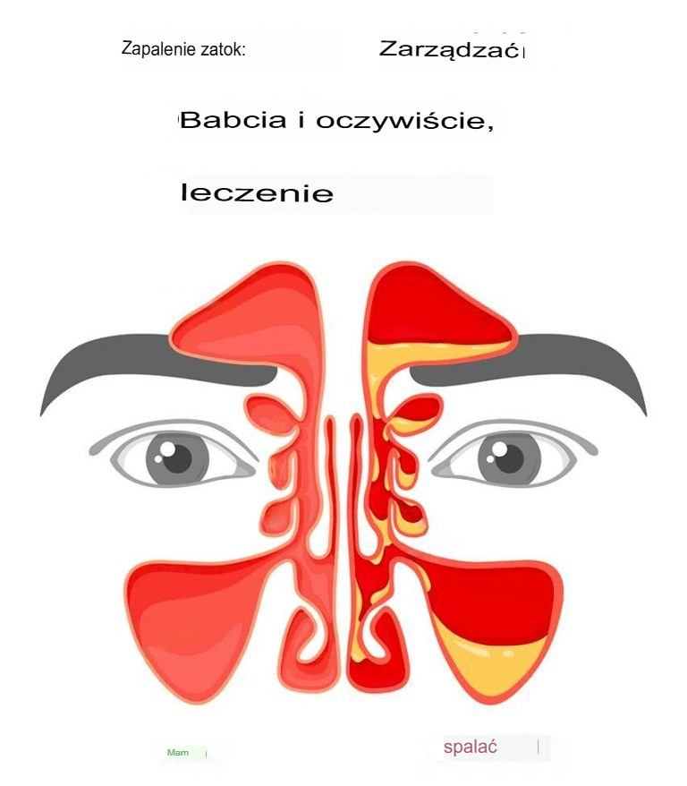 Zapalenie zatok: babcine sposoby i naturalne metody leczenia
