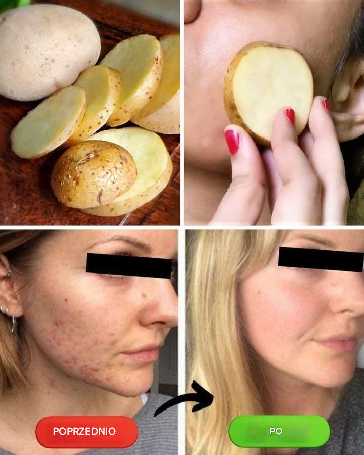 Pocieraj twarz plasterkiem ziemniaka każdego wieczoru – zdziwisz się, jak bardzo to pomaga!