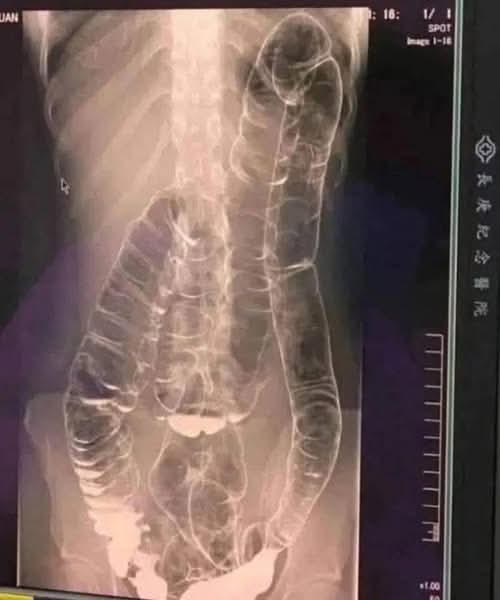 Nasycone jelito grube: kiedy organizm włącza alarm