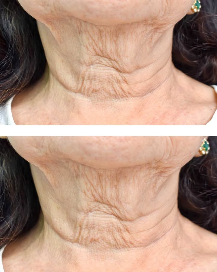 Jeśli nie dostarczasz organizmowi wystarczającej ilości tej witaminy, Twoja skóra może stracić elastyczność i pojawić się na niej zmarszczki