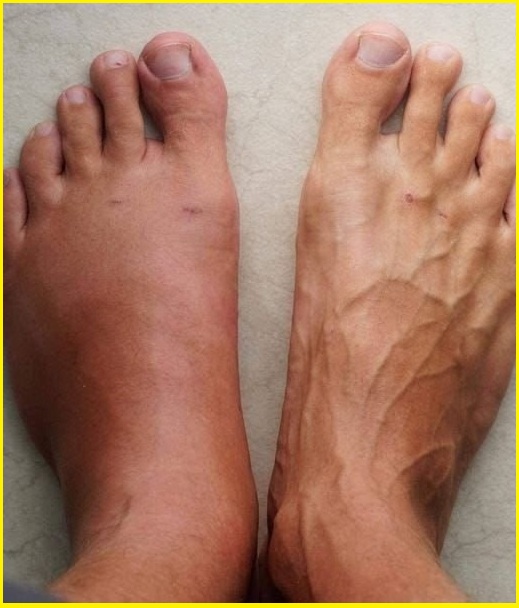 Twój organizm wysyła Ci 7 sygnałów na miesiąc przed zawałem serca