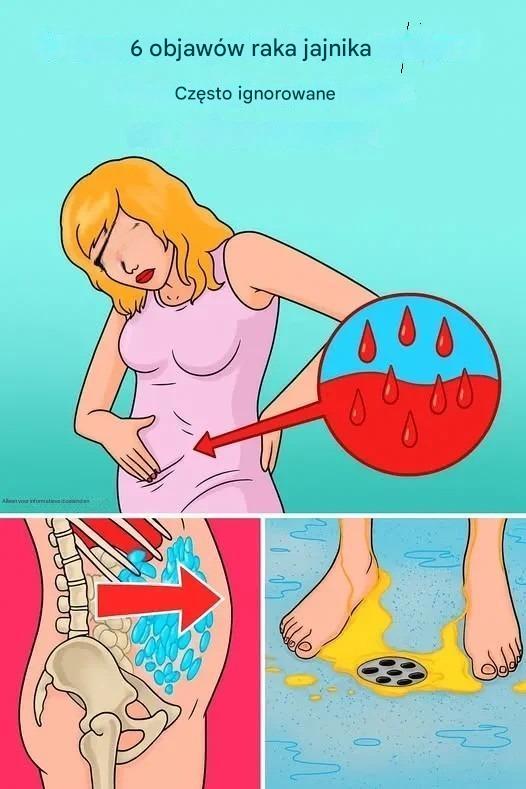 6 często pomijanych objawów raka jajnika