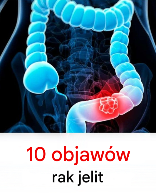 10 objawów raka jelita grubego