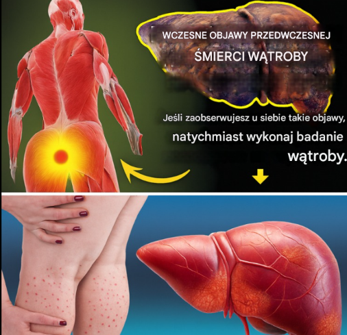 Myślisz, że jesteś zdrowy? Ale Twoja wątroba może się z tym nie zgadzać… Nie ignoruj ​​tych 12 ukrytych sygnałów ostrzegawczych! Wątroba to cichy pracownik organizmu. Filtruje toksyny, magazynuje składniki odżywcze, wspomaga trawienie i utrzymuje układ odpornościowy w stanie gotowości. Jednak wraz z rozwojem marskości wątroby może ona stopniowo osłabiać swoją zdolność do wykonywania tych funkcji. Co jest najbardziej przerażające? Wiele osób nie zdaje sobie sprawy z problemu, dopóki nie jest za późno. Marskość wątroby występuje, gdy zdrowa tkanka jest stopniowo zastępowana tkanką bliznowatą. Zwykle dzieje się tak po długotrwałym uszkodzeniu wątroby spowodowanym nadużywaniem alkoholu, przewlekłym zapaleniem wątroby lub stłuszczeniem wątroby. Wczesne wykrycie może mieć kluczowe znaczenie dla leczenia i przeżycia.  Czym jest marskość wątroby?