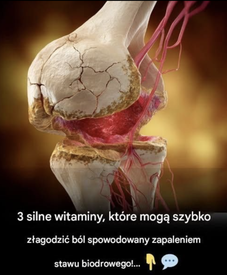 3 najlepsze witaminy na zapalenie stawu biodrowego – pożegnaj się z bólem stawu biodrowego
