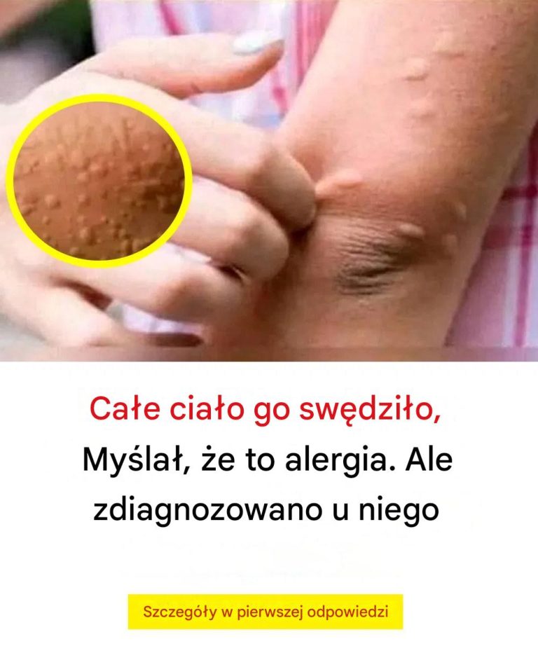 Zijn hele lichaam jeukte, hij dacht dat het een allergie was en kreeg de diagnose